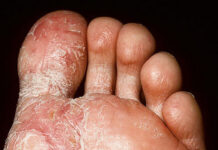 Экзема на ногах — эффективное лечение, причины и симптомы заболевания