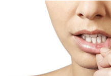 Язвочки в полости рта: причины и лечение (Ну, ты и язва! Откуда берутся ранки во рту и как от них избавиться)