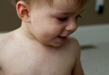 Розеола у детей: как выглядит сыпь, симптомы, лечение, профилактика, фото