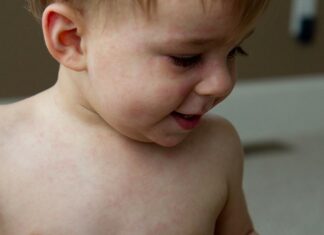 Розеола у детей: как выглядит сыпь, симптомы, лечение, профилактика, фото