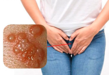 Лечение генитального герпеса у женщин | Клиника Здоровья