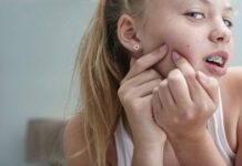 Как подростку избавиться от угрей на лице