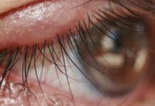 Ячмень под глазом — как и чем лечить, лечение, что делать, как вылечить