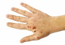 Экзема: причины возникновения, виды заболевания и методы лечения | Лекарственный справочник | Здоровье | Аргументы и Факты