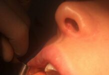 Удаление комков Биша — цена, показания и противопоказания, результаты и реабилитация