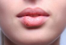 Герпес после татуажа губ: что делать и как избежать — Мед справочник