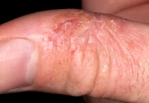 Экзема кончиков пальцев (fingertip eczema) — Клинические рекомендации