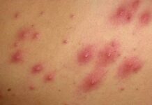 Шарик возле. Что делать, если появился твердый шарик под кожей. Когда нужно обратиться к врачу