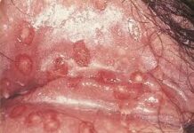 Генитальный герпес у беременных