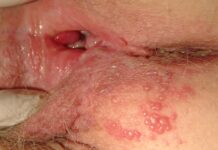 Герпес во влагалище: как избавиться.