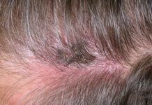 Герпес на голове в волосах. Лечение заболевания и фото | Женский журнал о красоте и здоровье