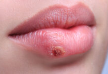Что делать, если после татуажа губ появился герпес, методы борьбы.
