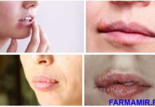 Что делать с пятнами после герпеса Медпортал ФармаМир каталог врачей и медцентров Москвы новости и статьи