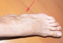 Гигрома стопы — симптомы, диагностика, лечение