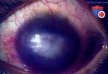 Диагностика глазной формы опоясывающего лишая. Лечение