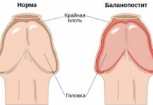 Баланопостит: причины, симптомы и лечение в статье уролога Ахмеров Н. М.