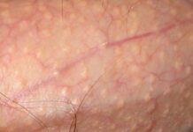 Появились пузырьки на члене: что делать?