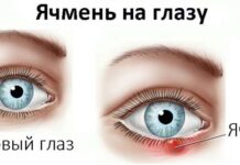 Можно ли греть ячмень на глазу — не станет ли хуже