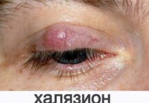 После ячменя осталась шишка на верхнем веке: что делать, как лечить, последствия и профилактика
