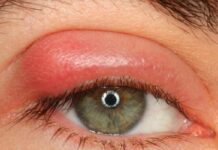 Лечение халязиона — причины и симптомы. Лечим халязион по уникальной методике в ЦТО