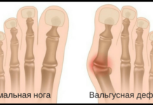 Шишки на ногах возле большого пальца — лечение, причины возникновения и симптомы | Медси на Пресне