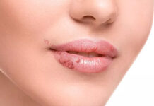 Правильное питание при герпесе. Полезные и опасные продукты при герпесе