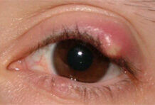 Ячмень на глазу: симптомы, причины, лечение — «»