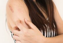 Лишай у человека — причины возникновения, симптомы, препараты и лекарства для лечения лишая