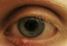 Можно ли ячмень мазать зеленкой | Лечение Глаз