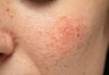 Купероз: причины, симптомы и лечение в статье дерматолога Тюлис Г. Г.