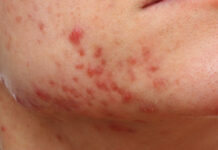 Как избавиться от постакне на лице советы дерматолога