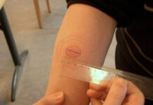 Как измерить Манту у ребенка: правильно, проверка пробы, как меряют размер папулы на линейке, реакцию на прививку, самостоятельно в домашних условиях, у детей 1 года