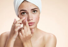 Как избавиться от комедонов на лице: полезные советы и методы лечения — ЛЕДИ СТИЛЬ ЖИЗНИ