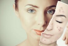 Комедоны на лице – лучшие методы лечения (ТОП-5 процедур)