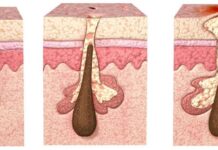 Комедоны: виды, причины появления и методы лечения