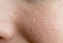 Комедоны | Медицинская эстетическая косметология