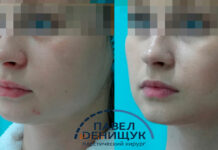 Как убрать брыли и сделать скулы — удаление комков Биша