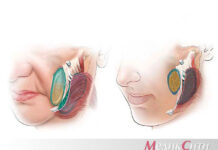 Удаление комков Биша: коррекция щек и скул