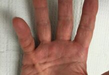 Лечение контрактура Дюпюитрена кисти без операции