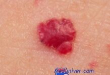 Купероз, гемангиома и розацея. Разновидности красных пятен на коже