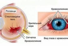 Кровоизлияние в глаз: причины, симптомы, лечение и диагностика
