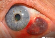Кровоизлияние в глаз, лечение (что делать), причины, симптомы, профилактика.