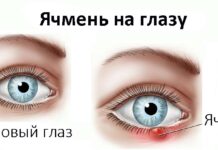 Ячмень на глазу у ребенка