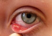Ячмень или халязион: как отличить по симптомам и вылечить правильно и быстро