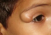 Рассасывающие мази от уплотнений под кожей