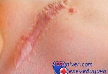 Пластическая хирургия в области устранения послеоперационных шрамов. Как удалить рубец?