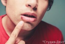Можно ли лечить зубы при герпесе на губах?