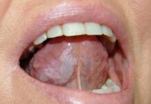 Разновидности лейкоплакии полости рта: симптомы и методы лечения