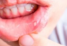 МАЗЬ ОТ СТОМАТИТА — взрослым и детям — названия и цены фото