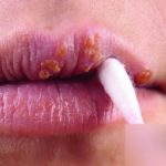 Герпес на губах при беременности в первом, втором, третьем триместре: чем лечить, чем опасен